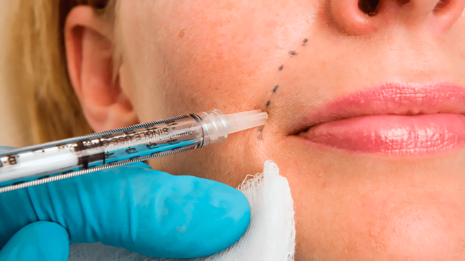 Facial Fillers