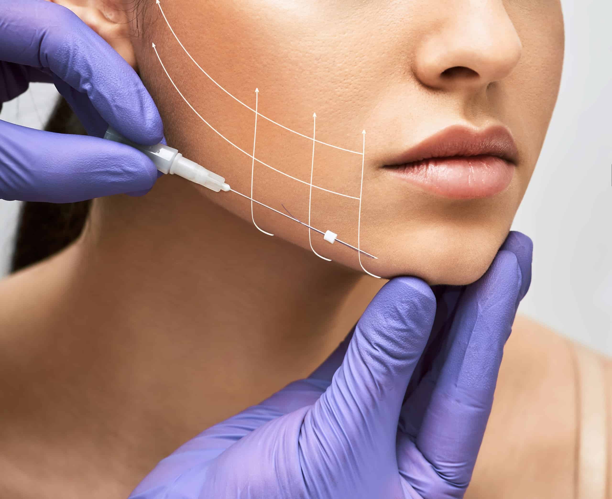 Facial Lift