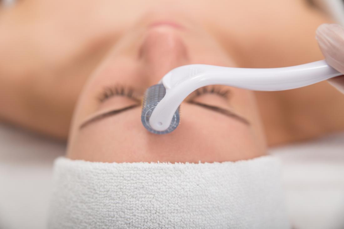 Microneedling