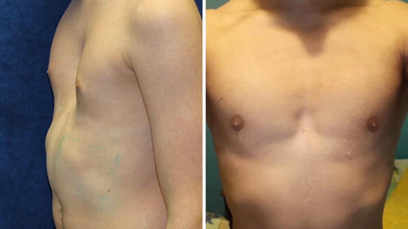 What Are the Causes of Flared Ribs, and How Can They Be Prevented ...