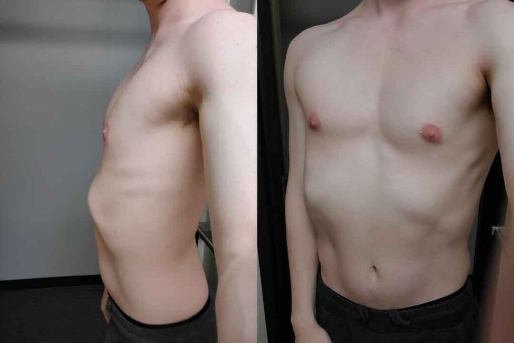 Understanding Rib Flare