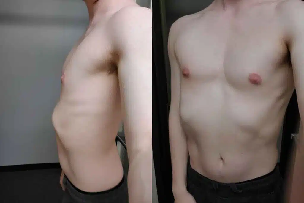 Understanding Rib Flare