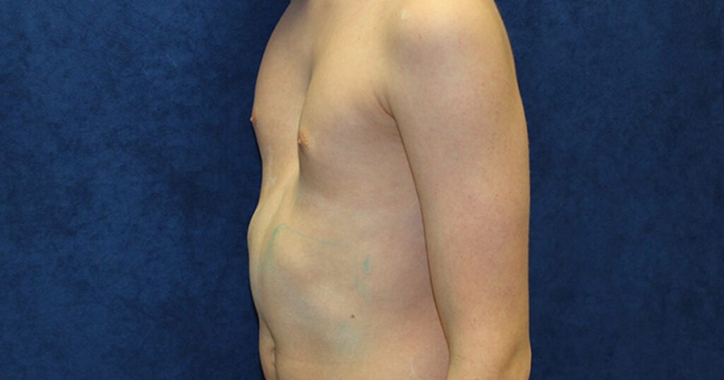 What is Rib Flare?