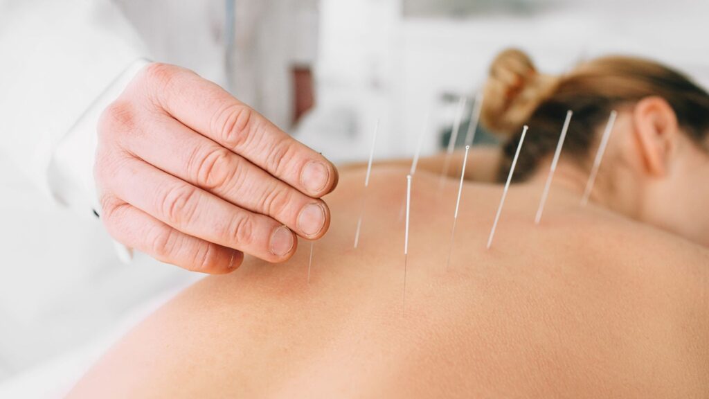 What is Acupuncture?